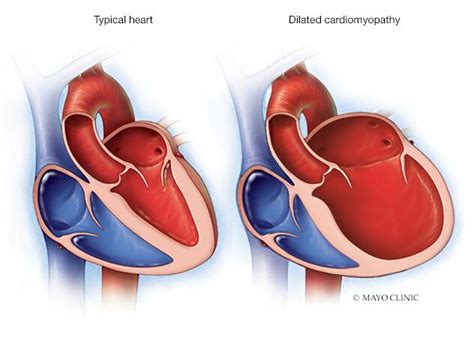 dilated lv means|dilated cardiomyopathy symptoms.